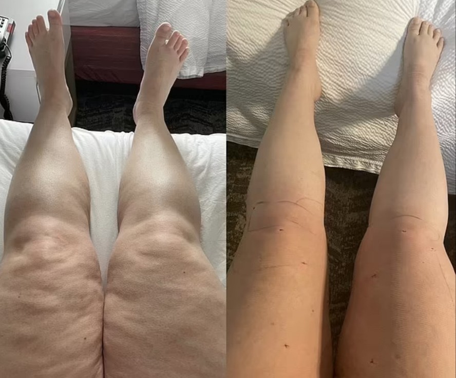 Antes e depois de Alisa Vandercruyssen drenar quase dois galões de água das pernas