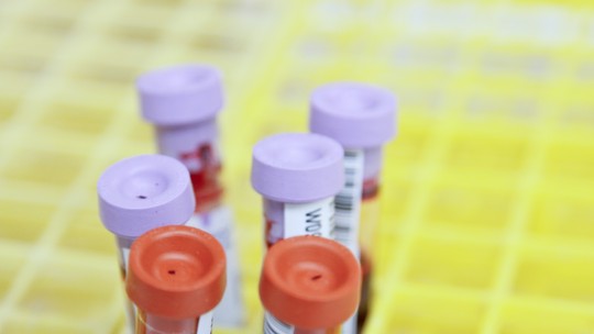 Ansiedade: pesquisadores desenvolvem exame de sangue para identificar a doença