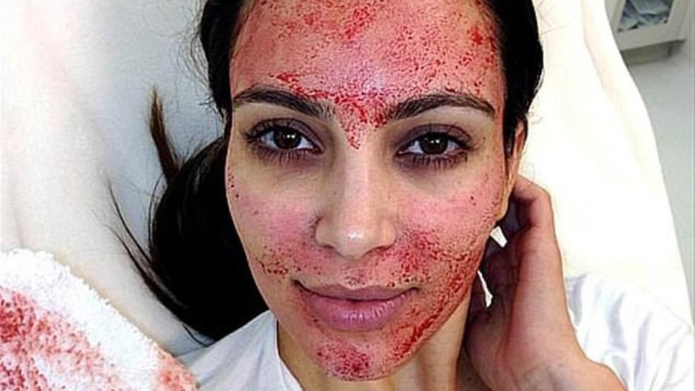 Kim Kardashian realizando o procedimento em 2013 — Foto: Reprodução