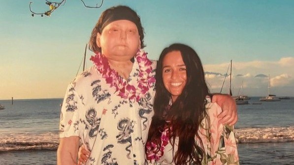 Joe DiMeo, de 24 anos, foi a primeira pessoa do mundo a passar simultaneamente pelos transplantes de rosto e de mãos — Foto: Reprodução