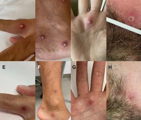 Lesões da varíola dos macacos em paciente na Itália.