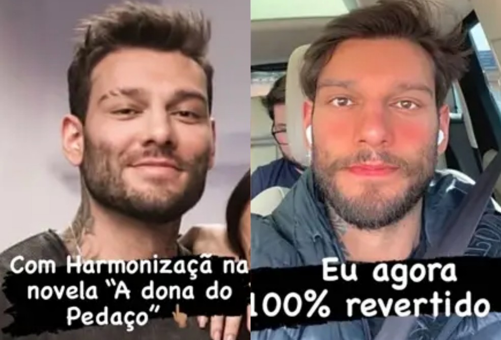 Lucas Lucco mostrou reversão de harmonização facial — Foto: Reprodução Instagram