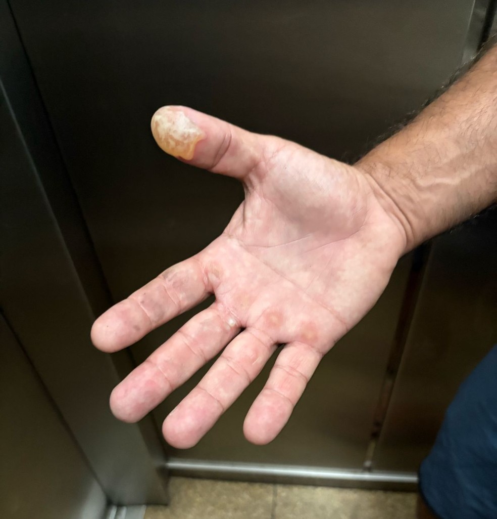 Mão de Aluísio Farias após o incêndio — Foto: Nathan Martins / Agência O Globo