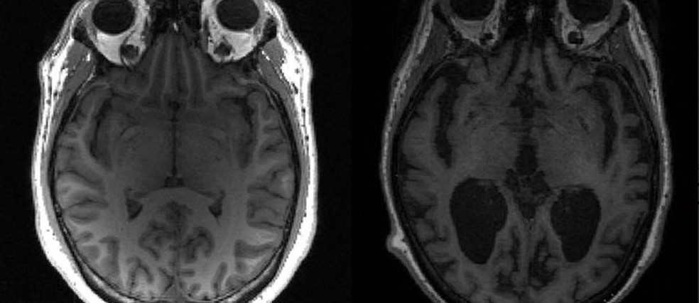 Imagem mostra cérebro saudável à esquerda e cérebro com Alzheimer à direita. Reprodução — Foto:         