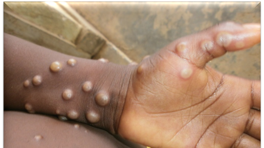 Ministério da Saúde cria sala de situação para monitorar varíola de macaco