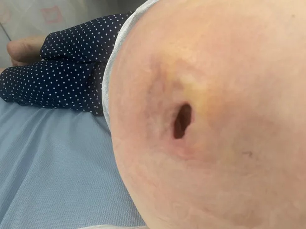 Ela passou por uma cirurgia de 1 hora para drenar o abscesso, que continha 50 ml de fluido &mdash; Foto: Kennedy News / Natasha Judge