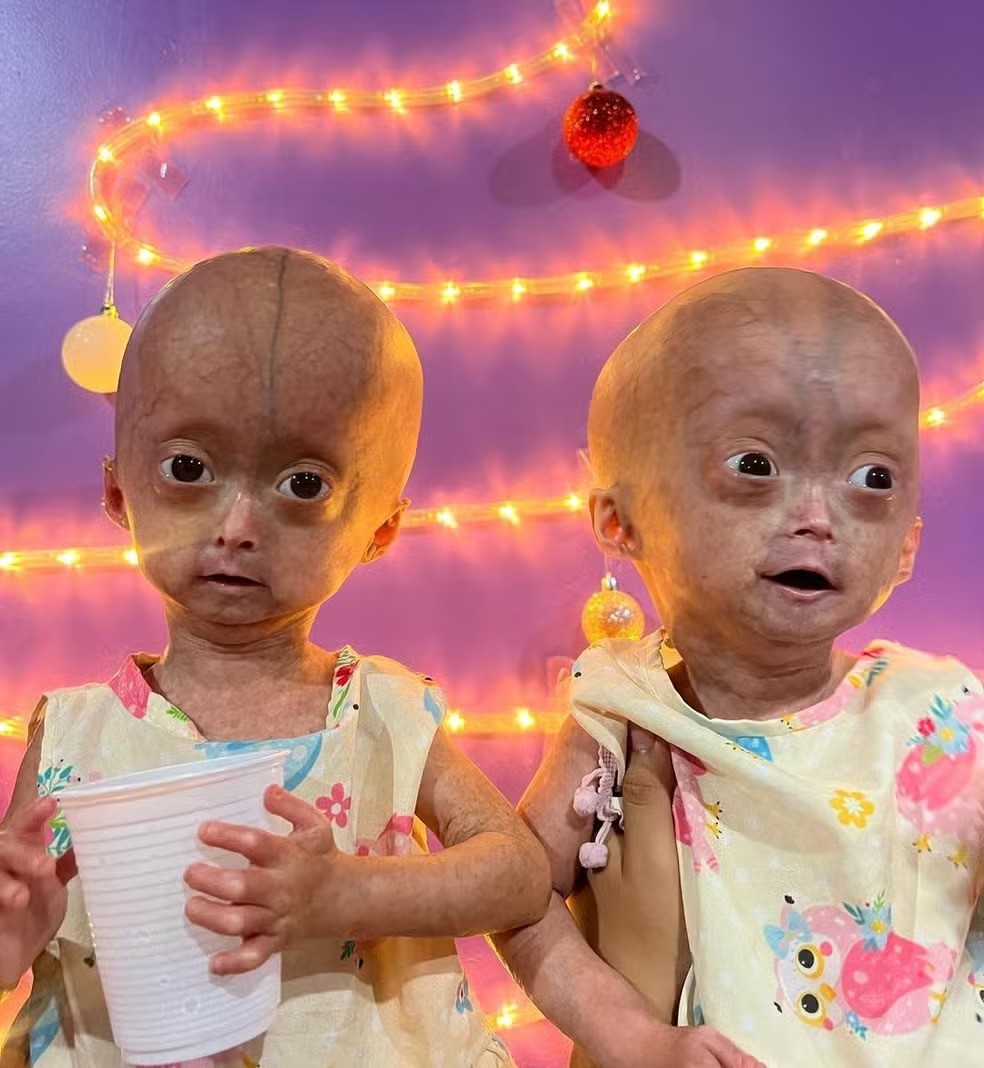 Image for Velhice precoce: entenda doença que acometia Elis, uma das gêmeas com síndrome rara que morreu aos 5 anos