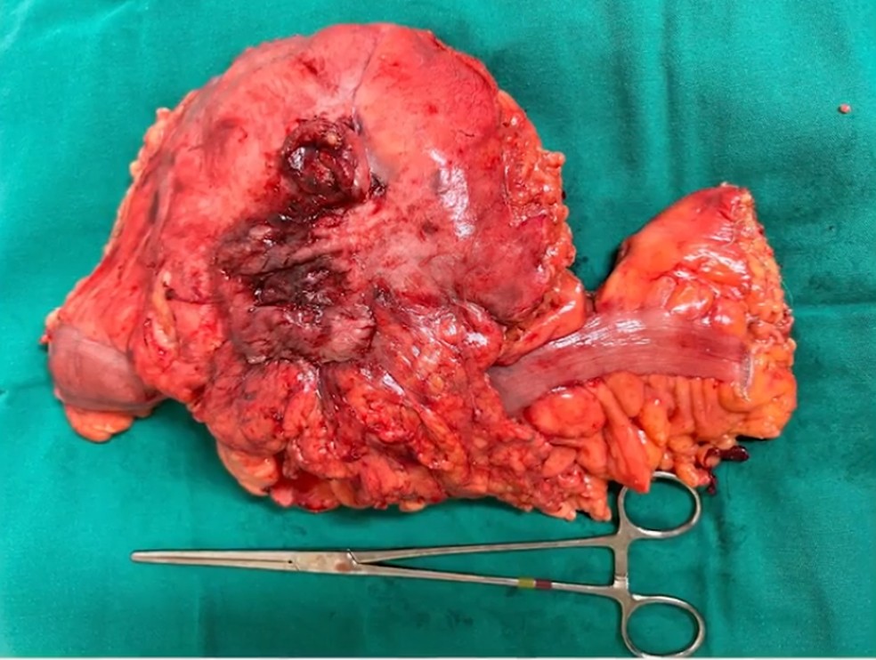 Divertículo gigante, com mais de 10 cm de diâmetro, retirado em caso raro no Rio de Janeiro. — Foto: Divulgação / Hospital Municipal Salgado Filho (HMSF) - Secretaria Municipal de Saúde do Rio de Janeiro