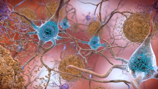 Alzheimer: fracasso de drogas e denúncia de fraude geram crise na pesquisa da doença