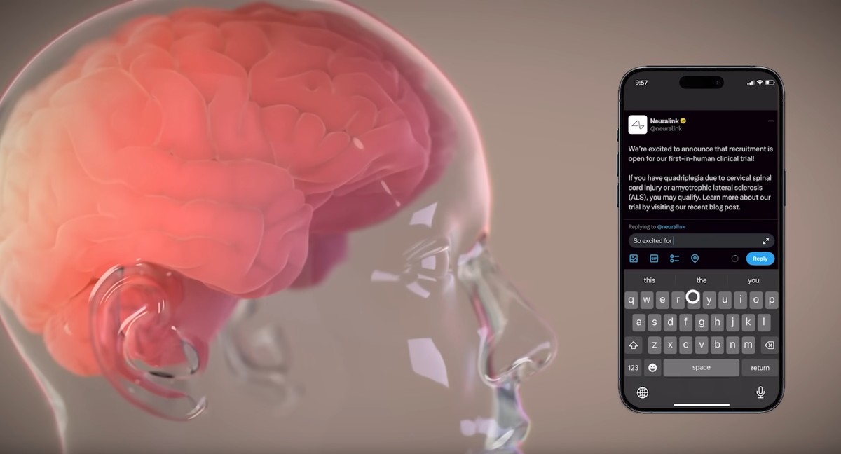 Elon Musk diz que Neuralink planeja produ&ccedil;&atilde;o 'em larga escala' de implantes  cerebrais em 2026; entenda