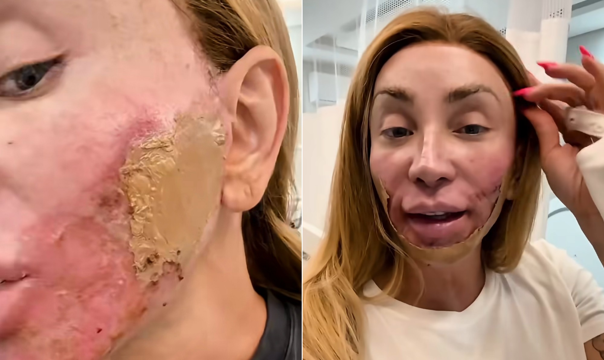 Line Skin: entenda o procedimento dermatológico feito por Maya Massafera que 'destrói' a pele