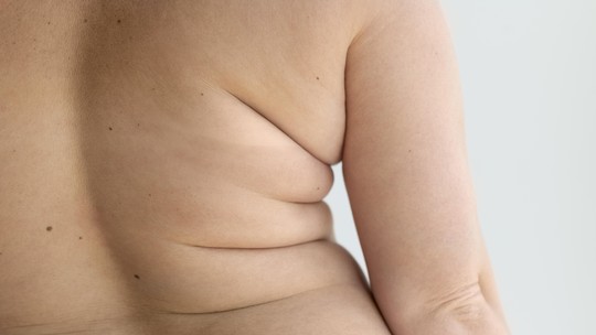 Obesidade aumenta o risco de desenvolver 32 tipos de câncer, afirma novo estudo; entenda