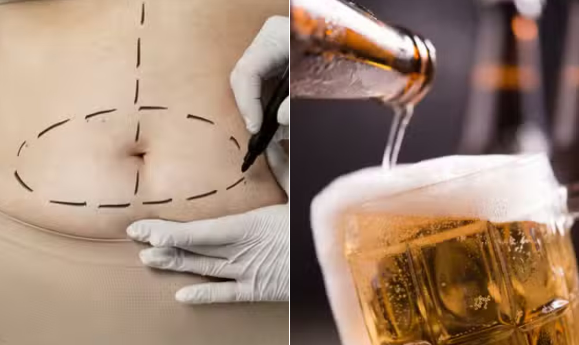 Cirurgia bariátrica eleva risco de dependência de álcool
