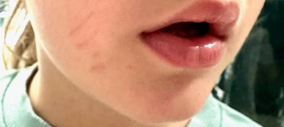 Scratches on V’s face. — Photo: Gabriela Salgueiro