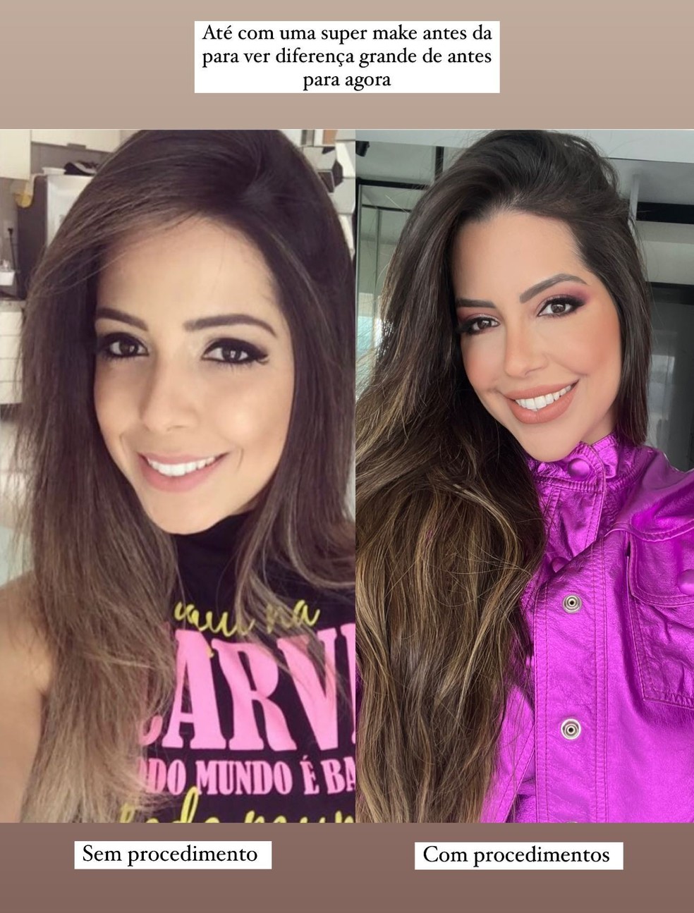 Antes e depois de Laís Caldas — Foto: Reprodução/Instagram