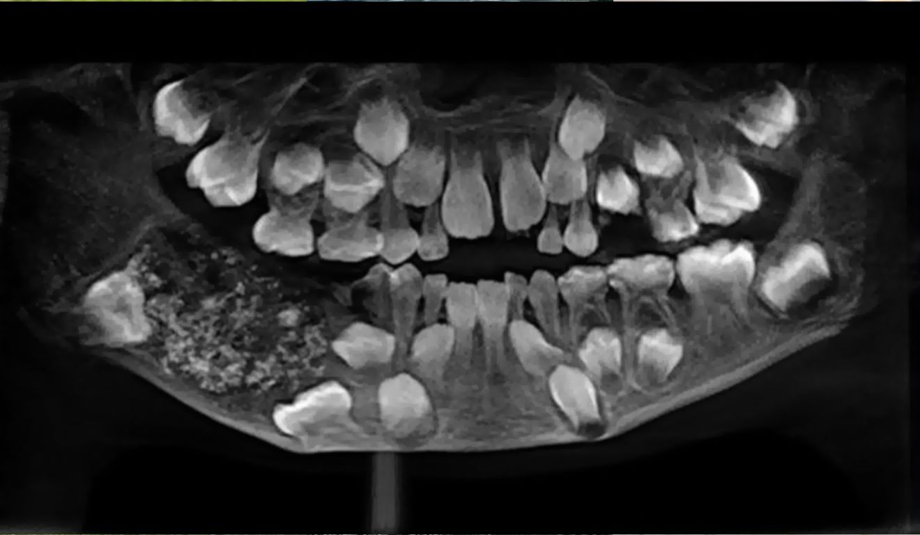 Recorde: cirurgia na Índia remove 526 dentes da boca de um menino de sete anos; entenda