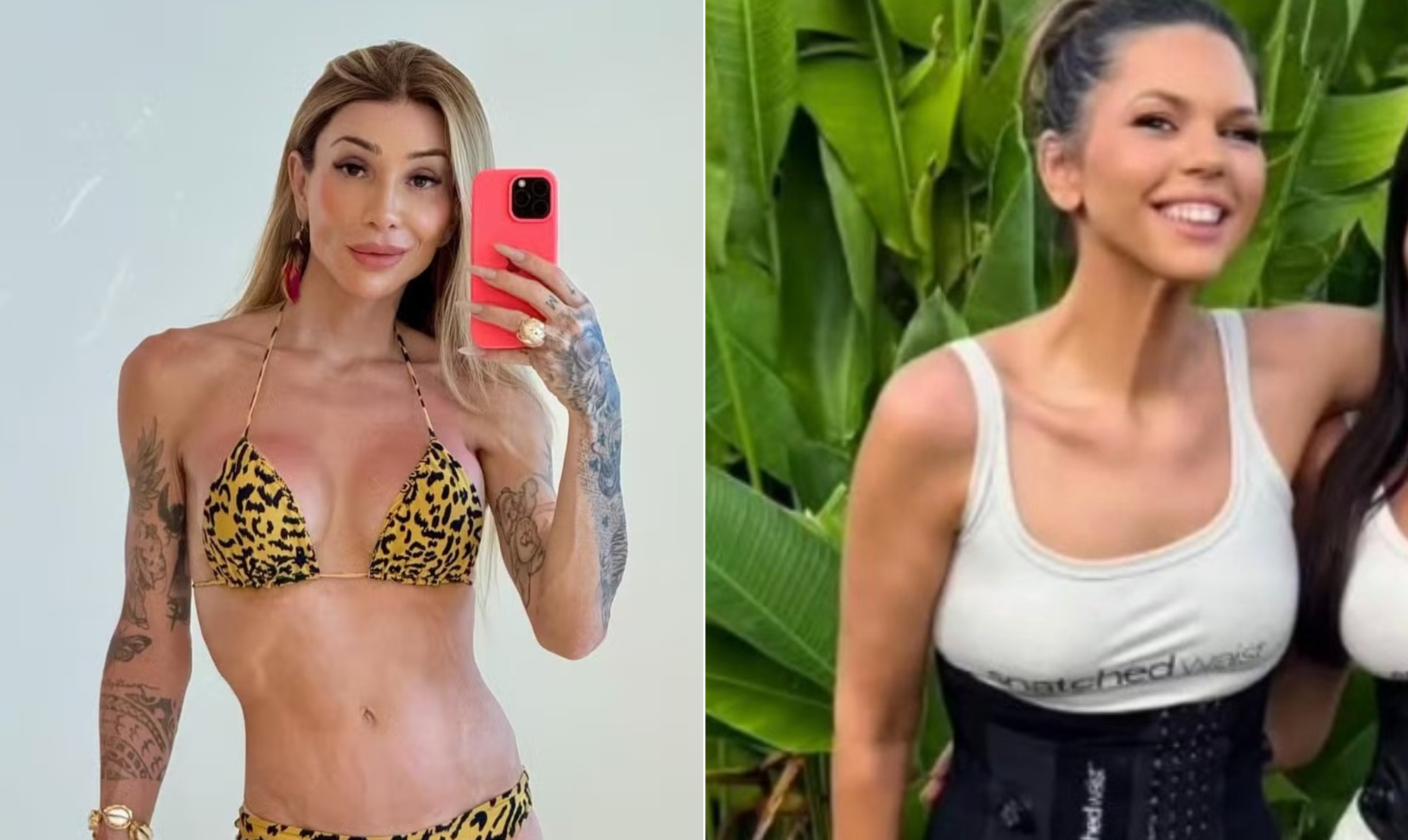 Remodelamento de costelas: cirurgia para afinar a cintura cresce nas redes; há riscos? - Foto