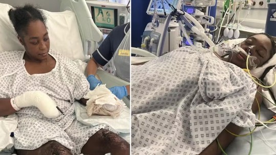 Mulher tem pernas e braço amputados após dar à luz a gêmeos na Inglaterra: 'Minha vida virou de cabeça para baixo'