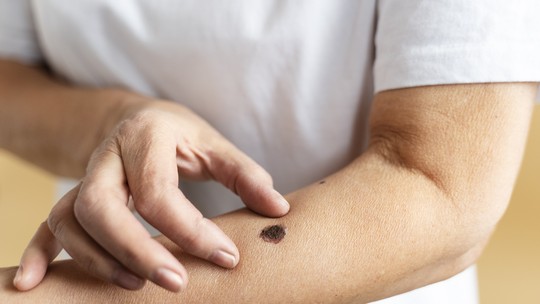 Câncer de pele: veja sintomas, causas e tratamento