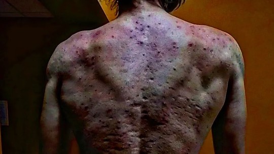 Jovem toma anabolizante e desenvolve quadro grave de acne nas costas: 'A dor mais intensa que já experimentei'