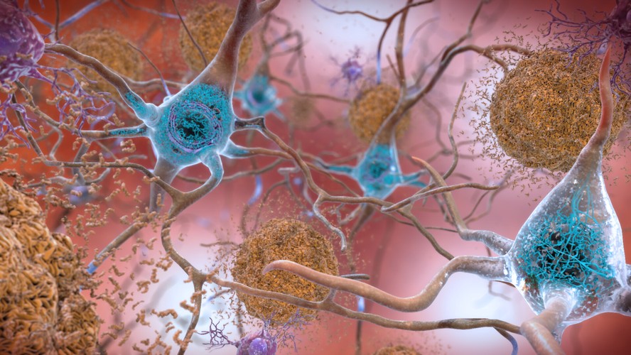 Ilustração mosra placas de proteína beta-amiloide (em laranja) entre neurônios de paciente do mal de Alzheimer