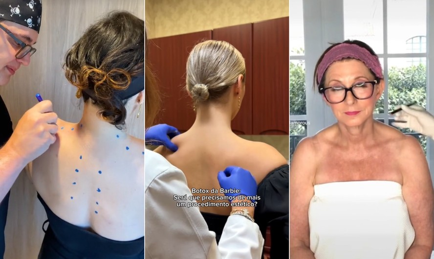 'Botox da Barbie' é viral no TikTok