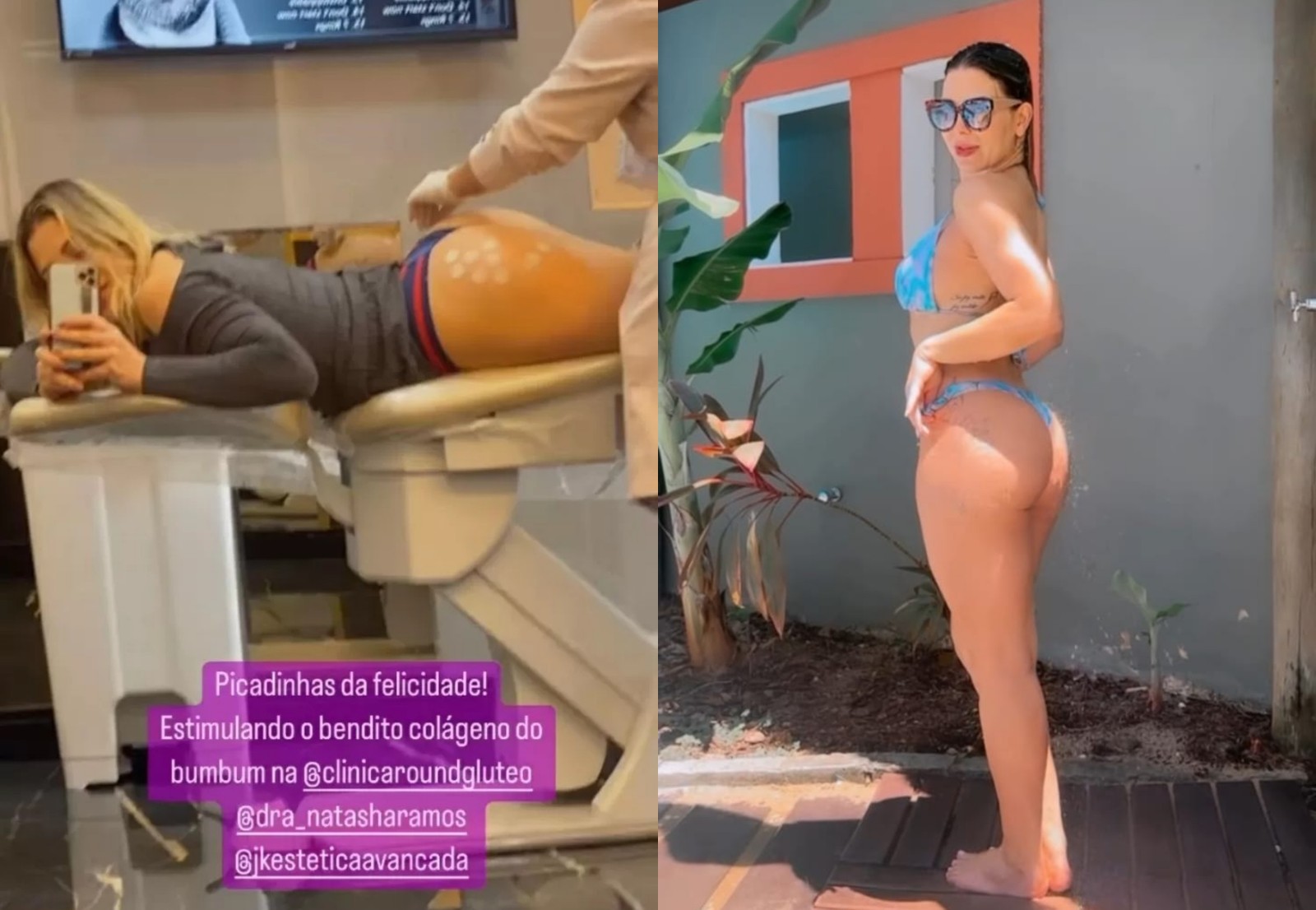 Sheila Mello passou por Pssodimentoestéticoa fim de se livrar da flacidez naregião do bumbum - foto: reprodução Instagram