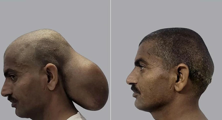 Homem sentia dores constantes no pesco&ccedil;o, m&atilde;os dormentes, dificuldade para andar e ins&ocirc;nia