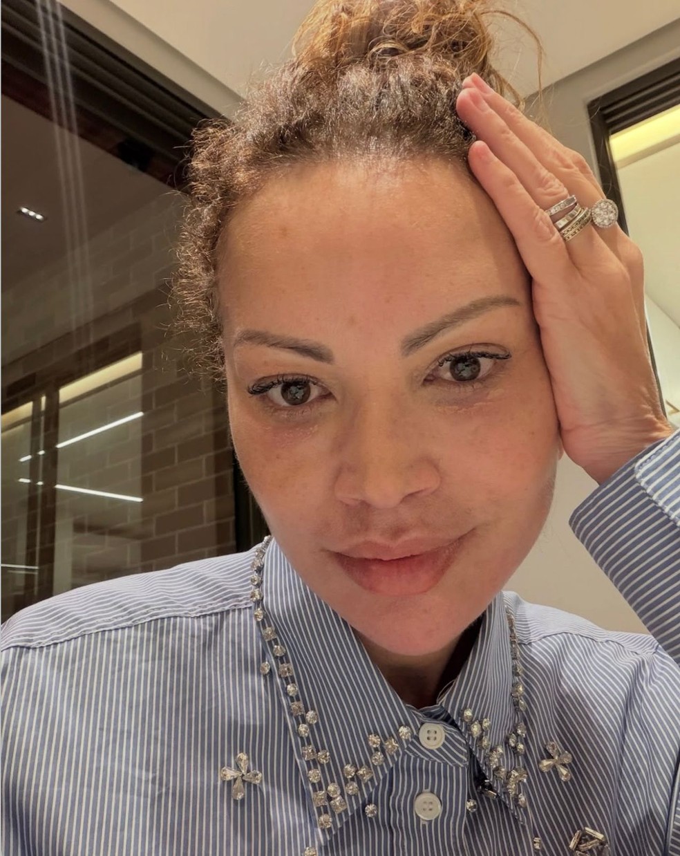 Entenda o lifting Deep Plane, técnica facial escolhida por Solange Almeida — Foto: Reprodução Instagram