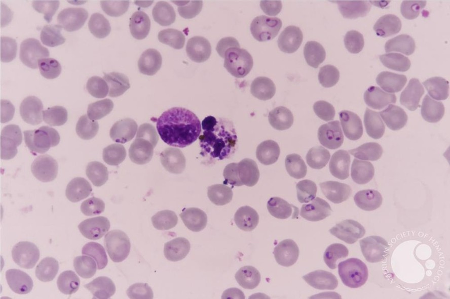 Plasmodium falciparum, um dos protozoários responsáveis pela malária