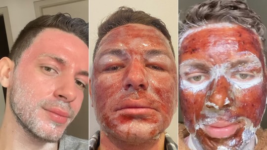 Peeling de fenol: homem viraliza com vídeo antes e depois da técnica com graves queimaduras no rosto; veja imagens