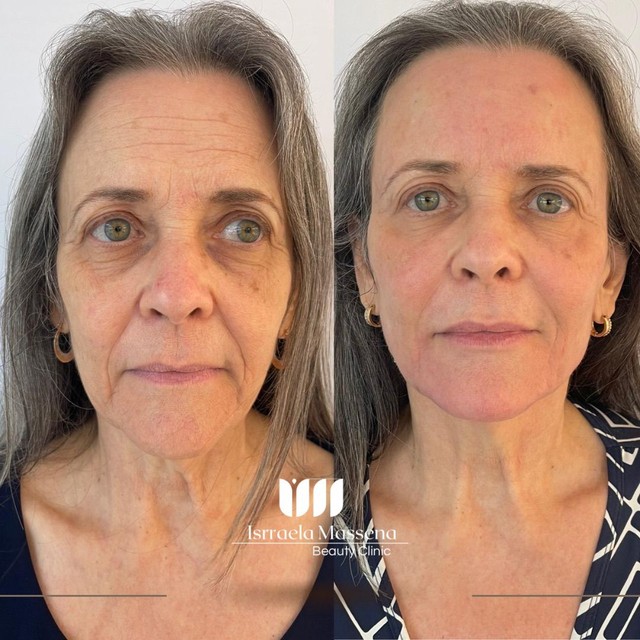 Bigode Chinês no rosto? Saiba como identificar + formas de tirá-lo