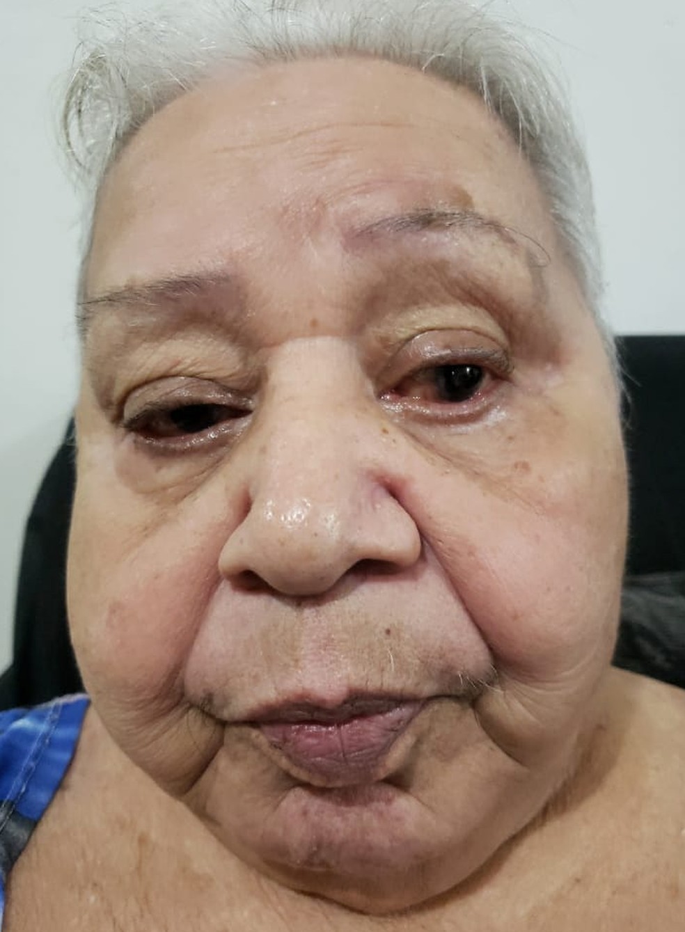 Valdelisse do Nascimento tem 80 anos e aguarda pela cirurgia desde o início de 2020 — Foto: Foto do leitor