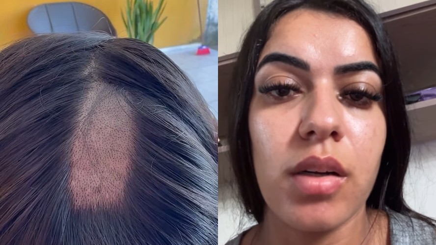 Mulher denuncia clínica por raspar cabelo indevidamente em exame toxicológico