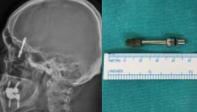 Parafuso de implante dentário vai parar em cérebro de paciente, após procedimento malsucedido; entenda