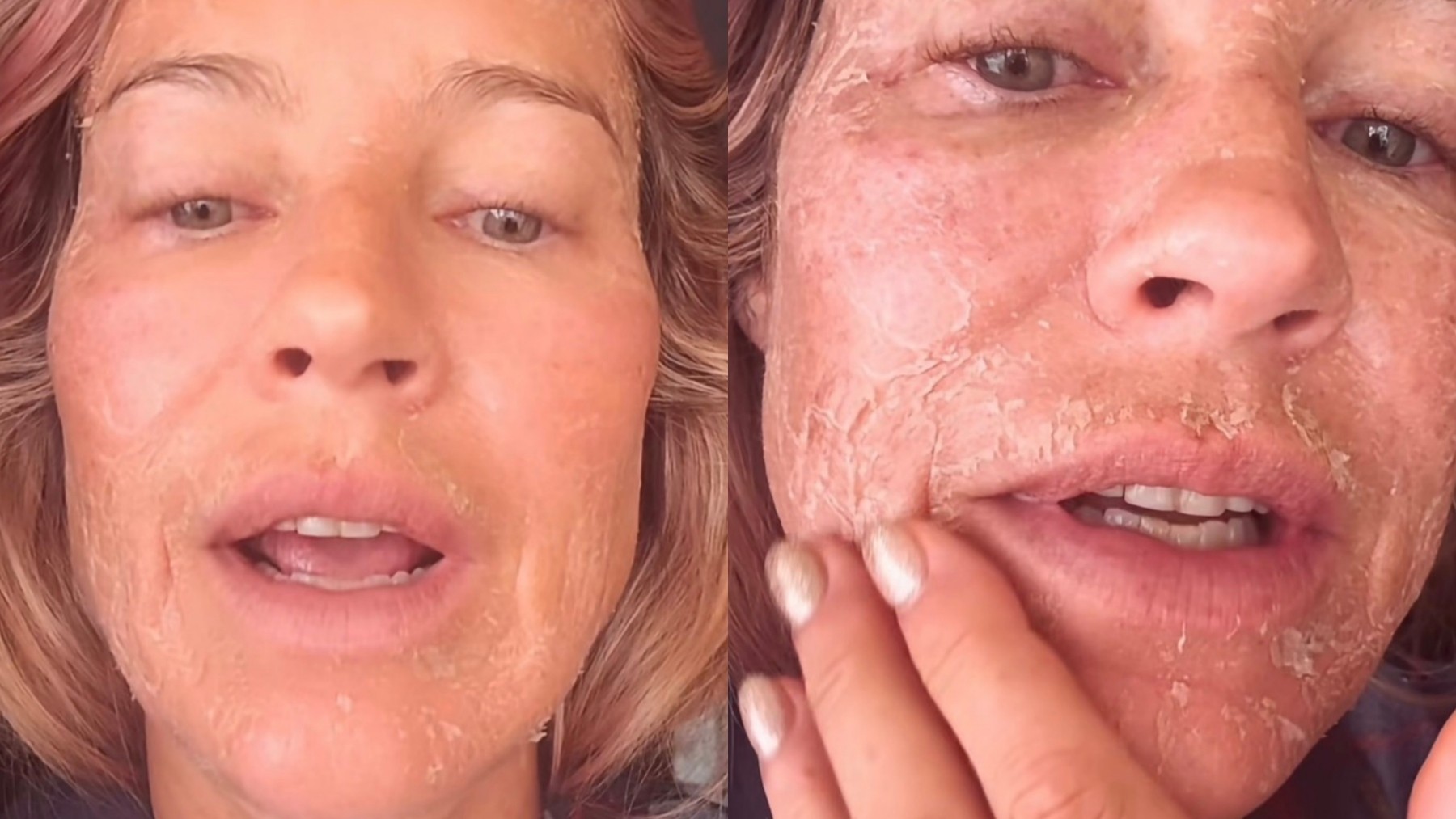 Luana Piovani: por que a pele descama depois do laser? Entenda - QTU Questões do Universo