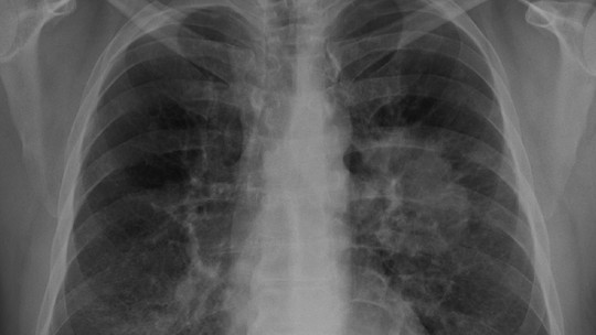 Nova droga reduz pela metade risco de morte de pacientes de câncer de pulmão operados