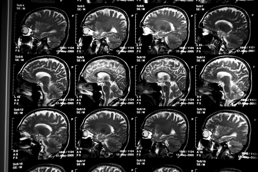 Exames de cérebro de paciente com Alzheimer.