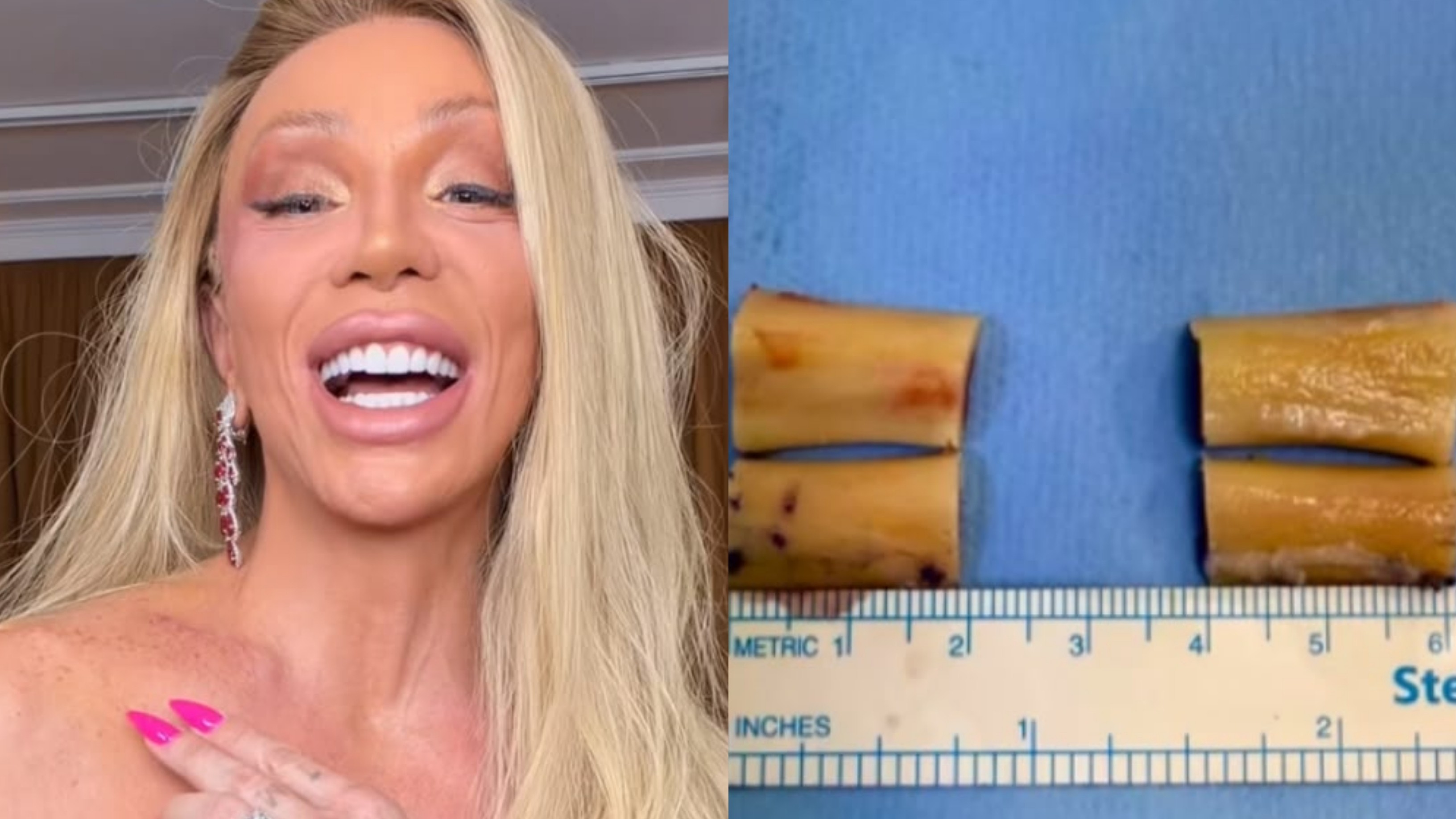 Maya Massafera mostra resultado da cirurgia para reduzir os ombros e exibe ossos removidos