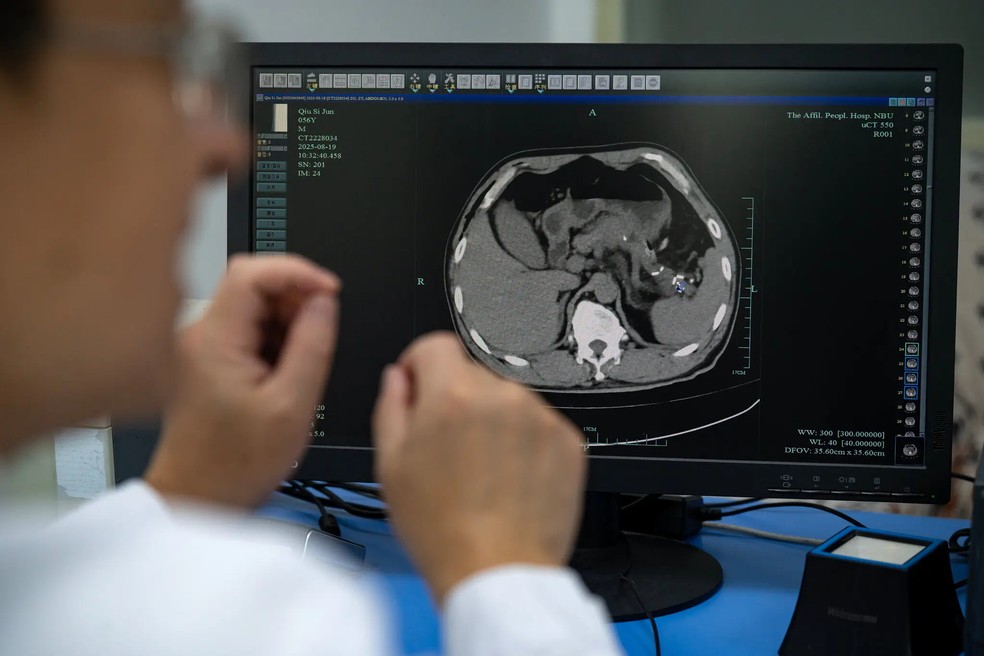Ferramenta de IA procura câncer de pâncreas em tomografias sem contraste, que não mostram anormalidades de forma tão clara quanto exames com uso de contraste. — Foto: Andrea Verdelli / The New York Times