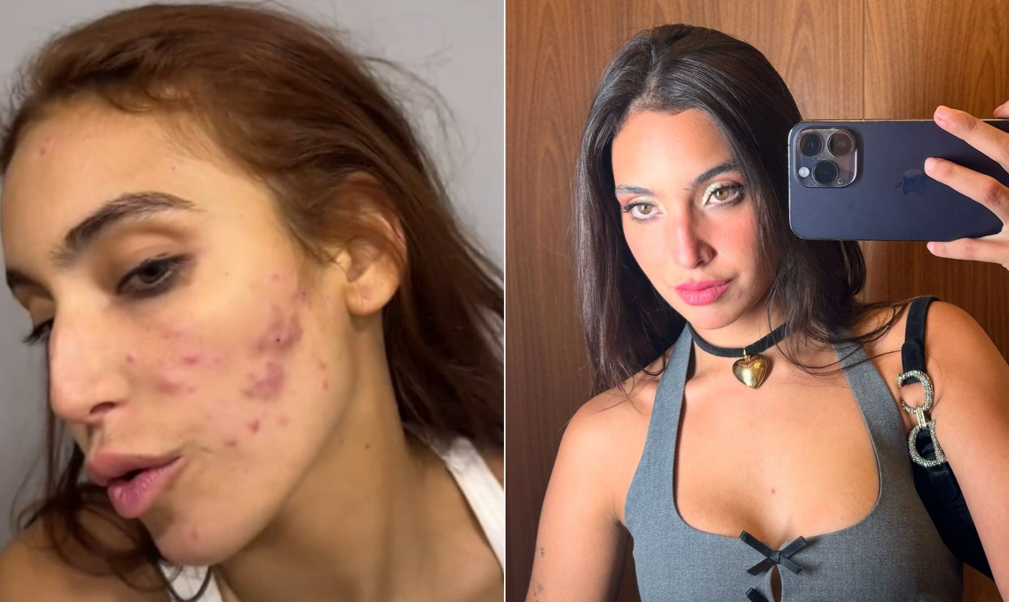 Vanessa Lopes: entenda as causas e os tratamentos da acne adulta; como a que afetou a influenciadora