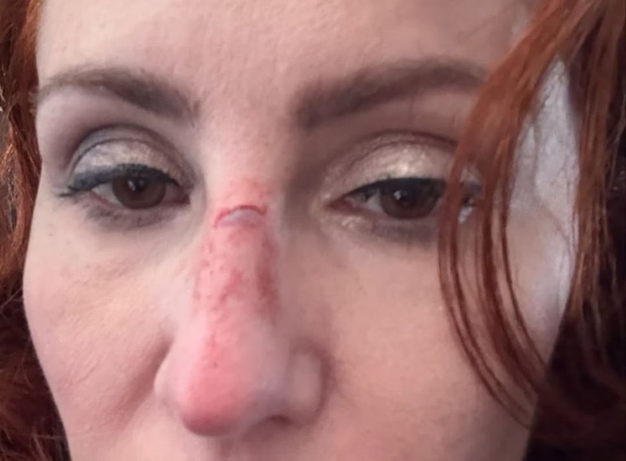 Carla Zambelli com ferimento no nariz