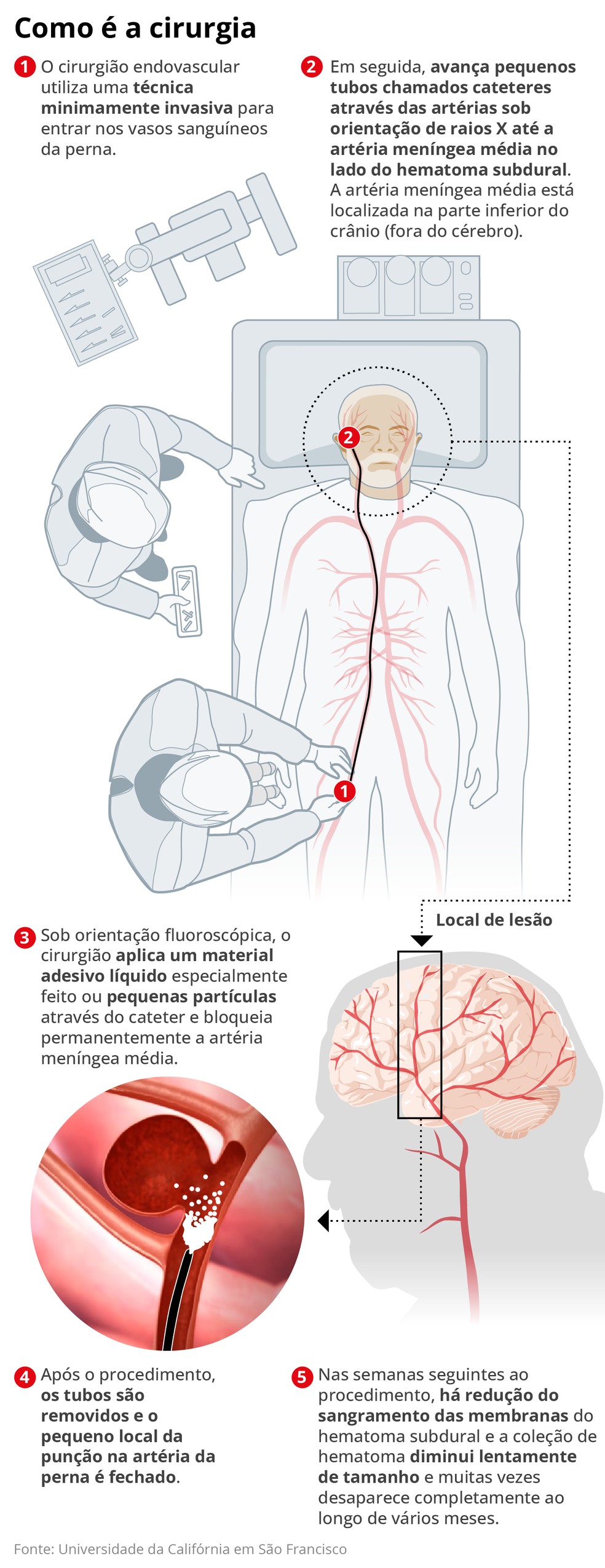 Como é a cirurgia — Foto: Editoria de Arte