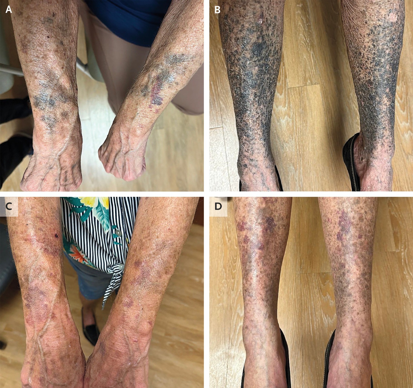 Idosa dos EUA fica com pele azulada e preta após reação rara a antibiótico para rosácea; estudo analisou caso
