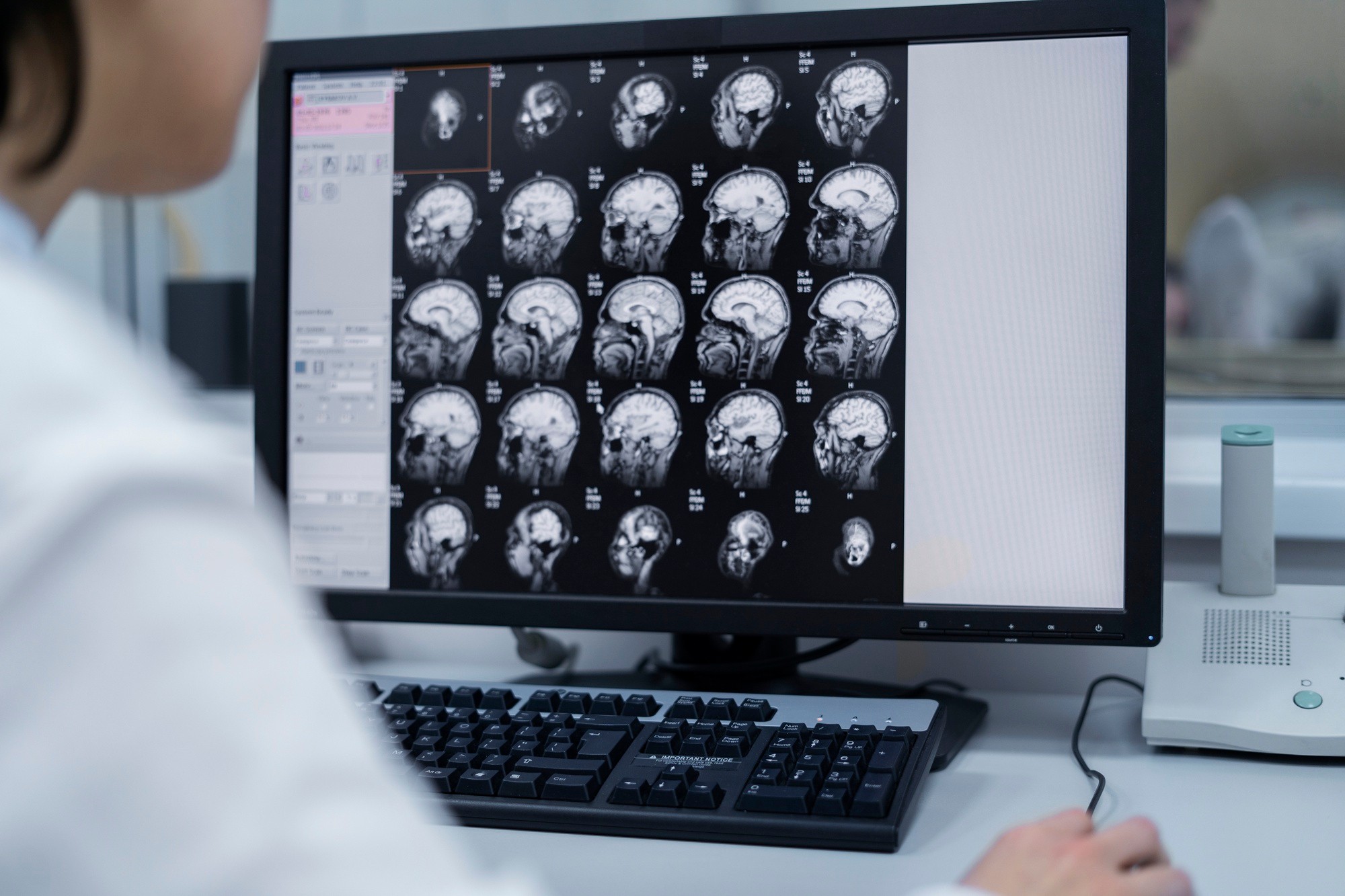 Estudo Revela Alterações Cerebrais Ligadas ao TOC