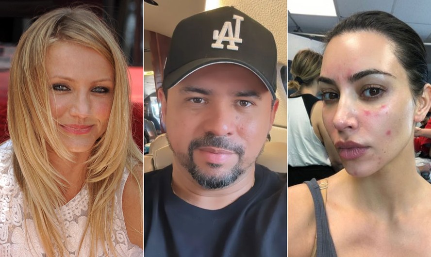 A partir da esquerda: Cameron Diaz, Xand Avião e Kim Kardashian, famosos que sofrem com a psoríase