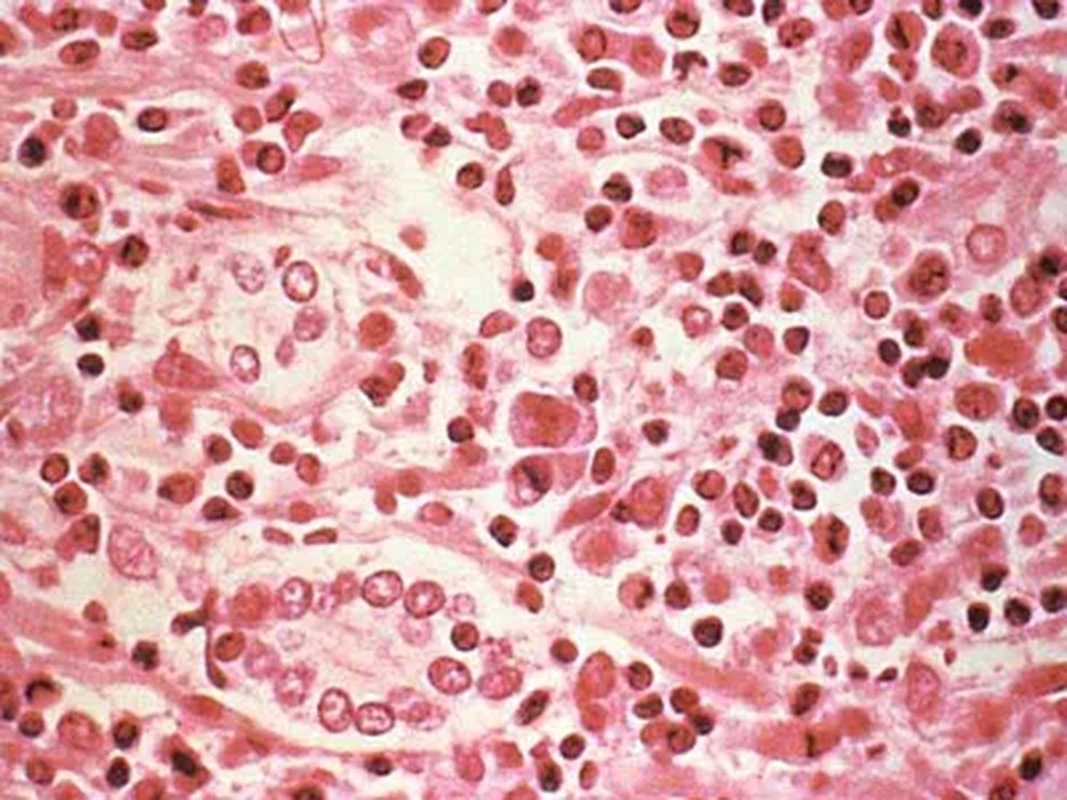 Imagem de tecido do fígado afetado por hantavírus — Foto: Reprodução: britannica.com