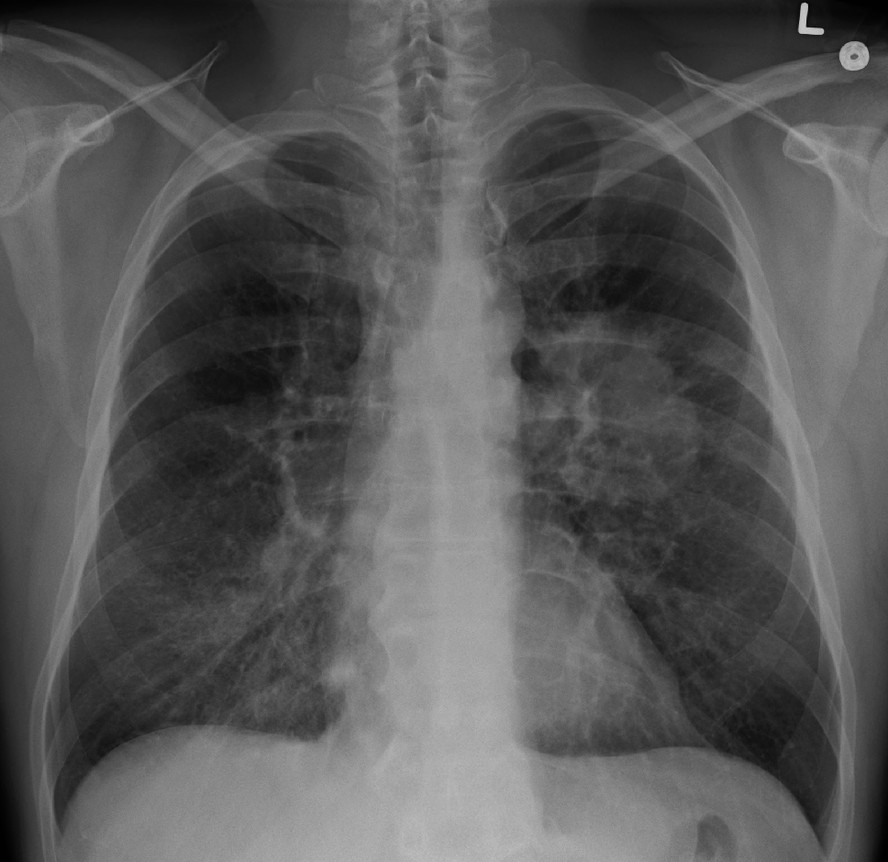 Chapa de raio-x de paciente com câncer de pulmão