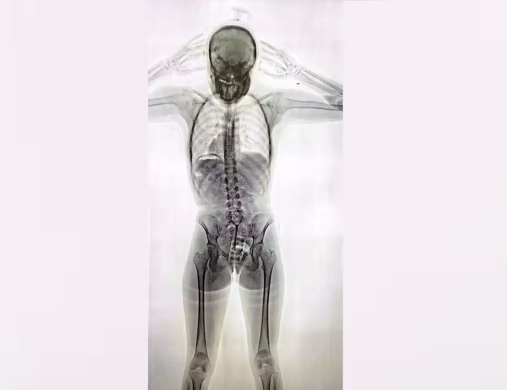 Jovem é presa na Argentina com 78 cápsulas de cocaína no corpo; veja raio X