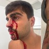 Gustavo terá de fazer um procedimento para reparação do canal lacrimal - Arquivo pessoal